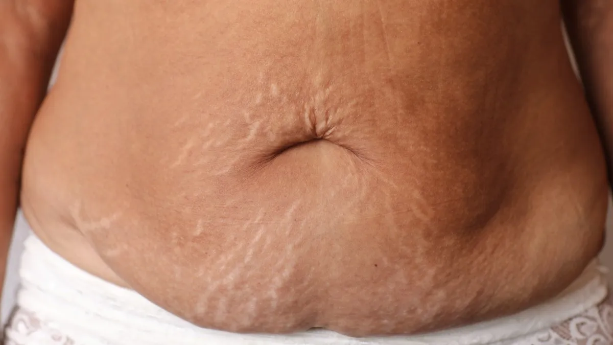  Mild Skin Laxity