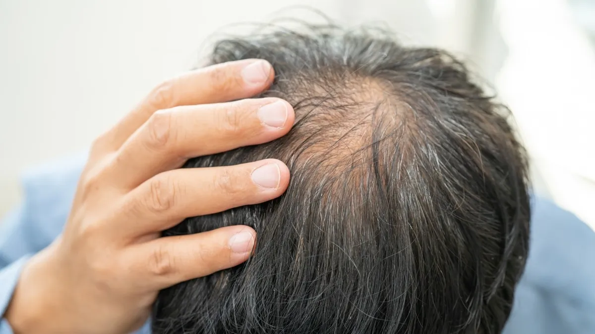 5 Common Causes of Hair Loss and When PRP Is Most Effective
