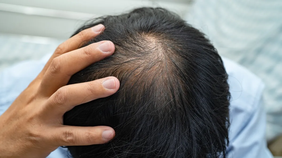 Hair Loss Treatment Near Kandigai, Chennai: Top 5 Clinics (2026)