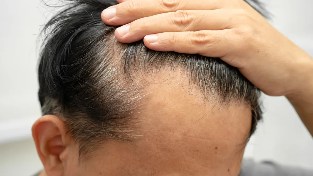 5 Best Hair Loss Treatment Clinics in Medavakkam, Chennai (2026)