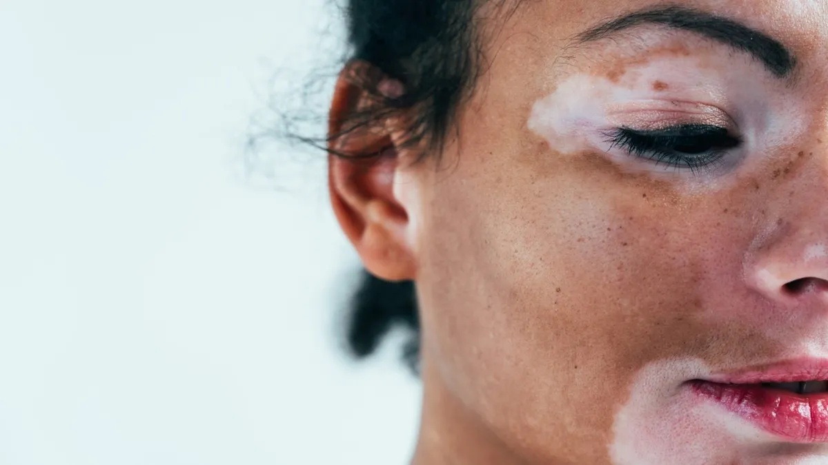 Melasma (Selected Cases)