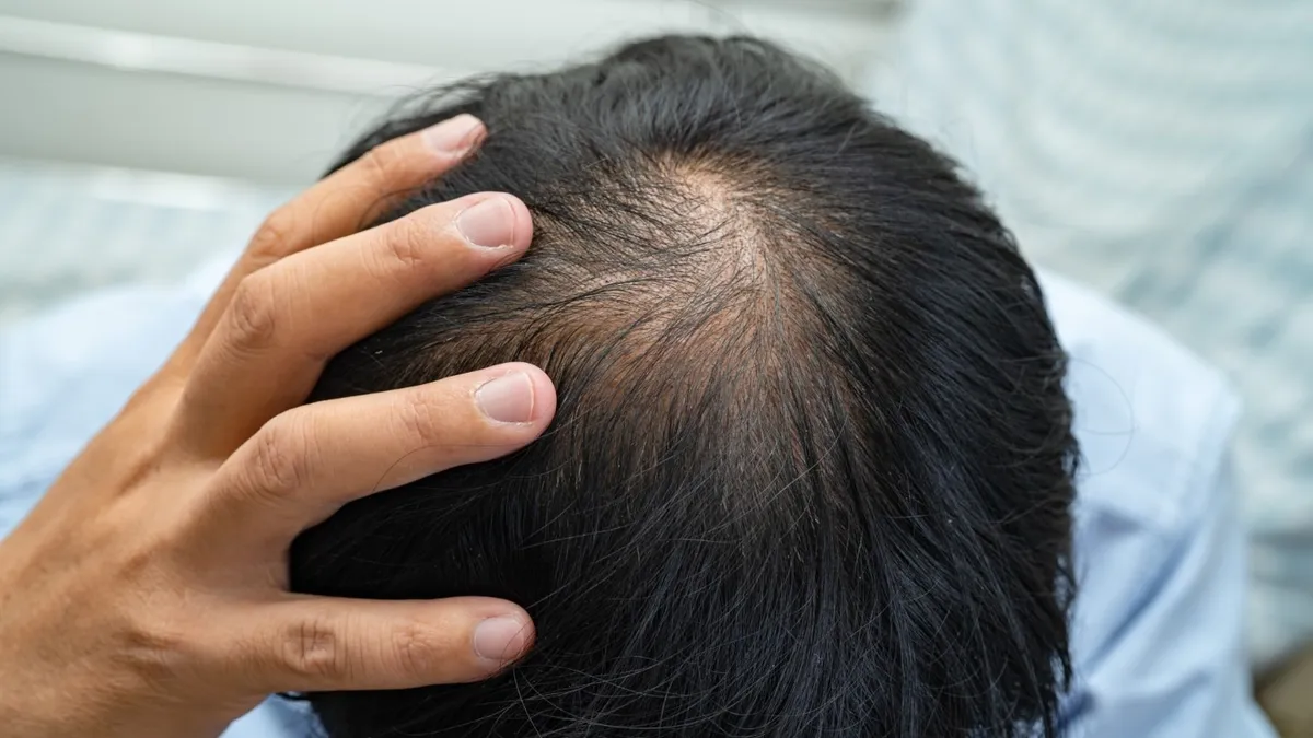 Hair Loss and Scalp Conditions