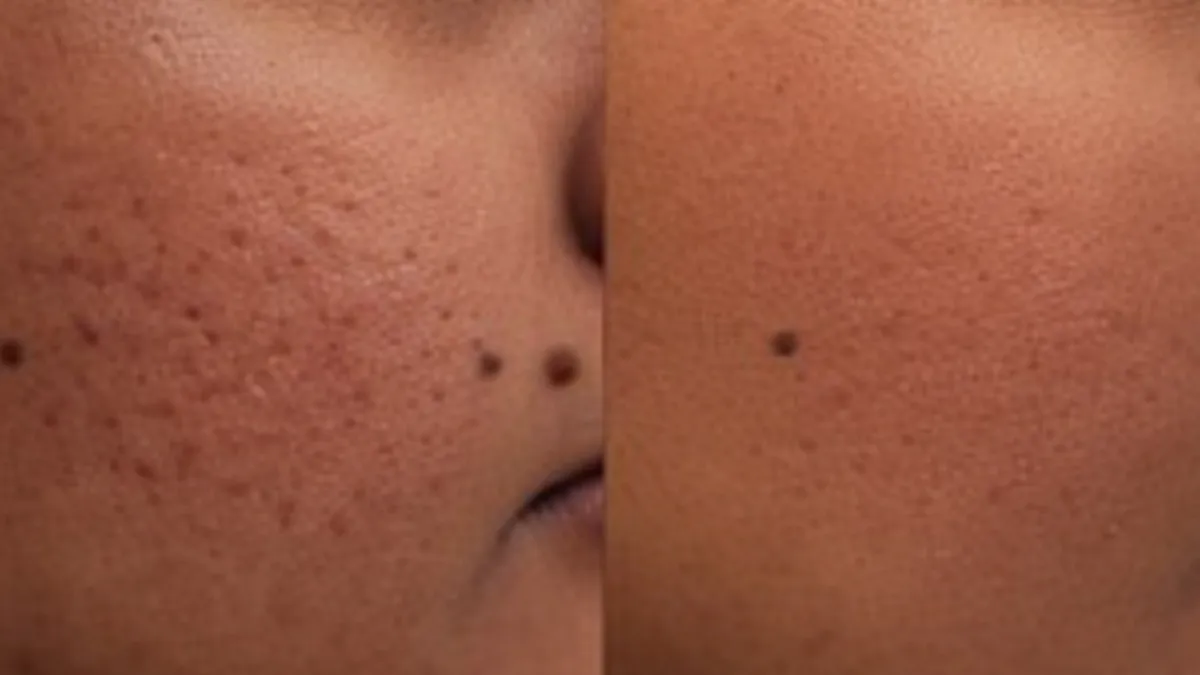 CO₂ Laser for Acne Scars Near Padur, Chennai: Treatment Guide and Clinic Options