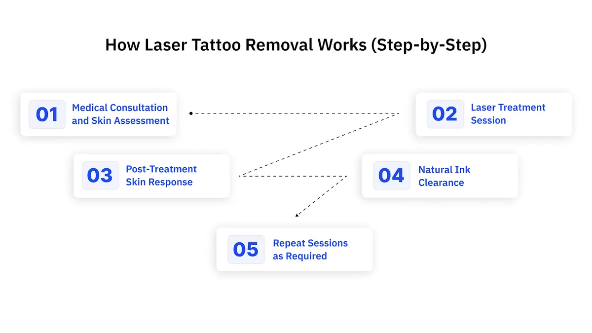 How Laser Tattoo Removal Works (Step-by-Step)