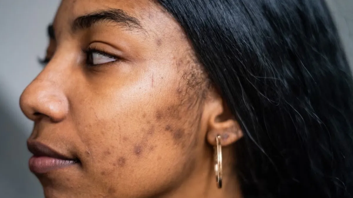 Acne Scars