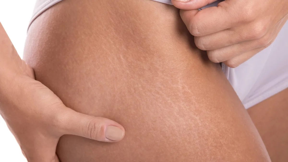 Effective Stretch Mark Removal Options and Treatments