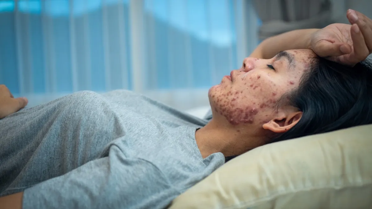 Acne Scars