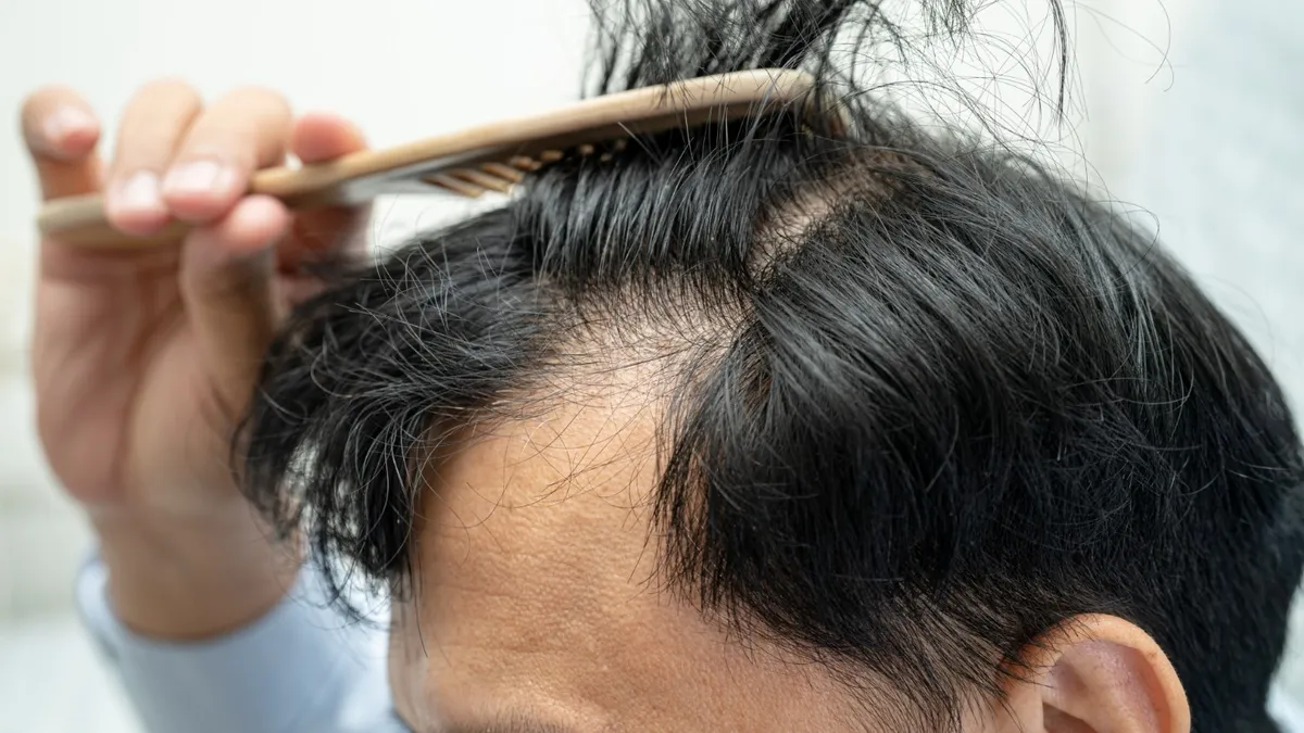 Hair Loss Treatment Near Kovilancheri, Chennai: 5 Clinics To Consider