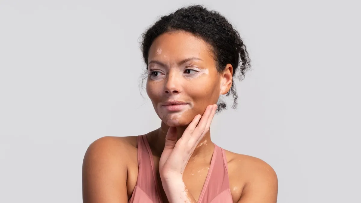 Effective Vitiligo Treatment in Chennai for Restoring Skin Tone